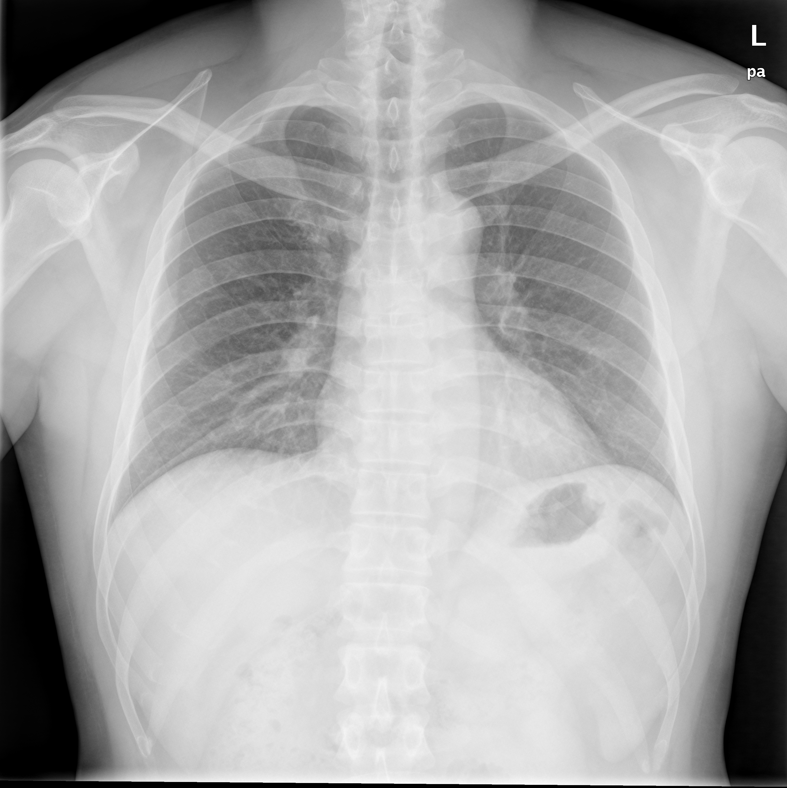 chest x-ray image